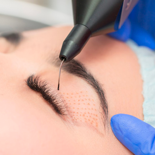 Professional Fibroblast Training: Mastering Plasma Pen Techniques